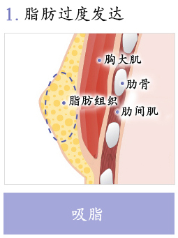 男性乳房肥大矫正术-去除不必要的脂肪组织和乳腺腺体组织