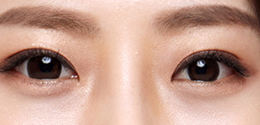 开眼角-想象你自己的眼睛看起来大而自然-整形美容案例 开眼角-想象你自己的眼睛看起来大而自然