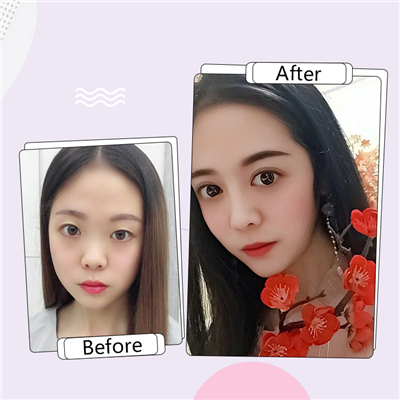 高分子埋线双眼皮