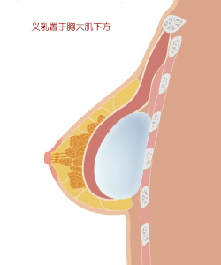 义乳置于胸大肌下方示意图