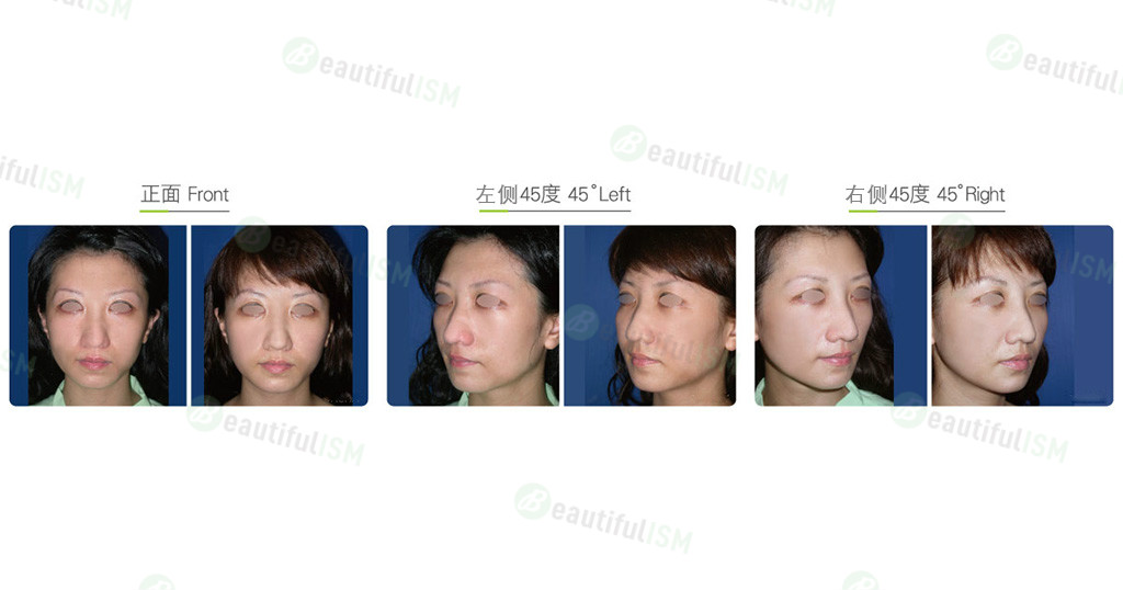 自体脂肪移植-太阳穴/双脸颊脂肪填充（女）效果图,案例前后对比照片