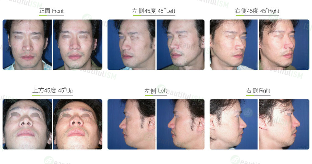 鼻骨缩减+韩式隆鼻（男）效果图,案例前后对比照片